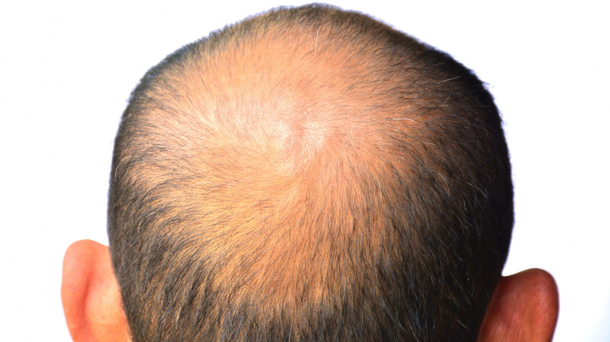 Balding Cure A Step Closer With Latest Round Of Research