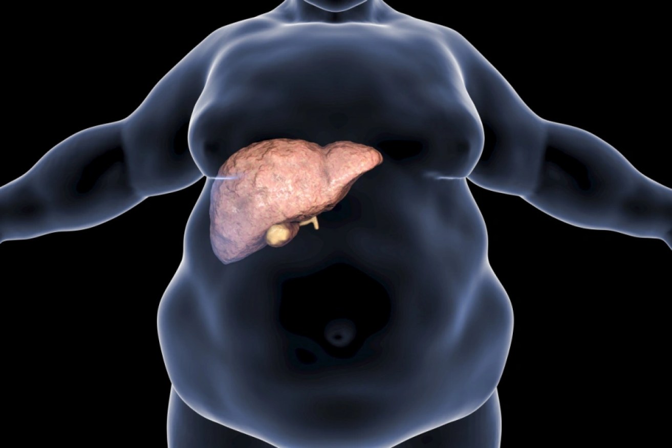 Obesity often goes hand in hand with fatty liver disease, which in turn predicts heart failure.   