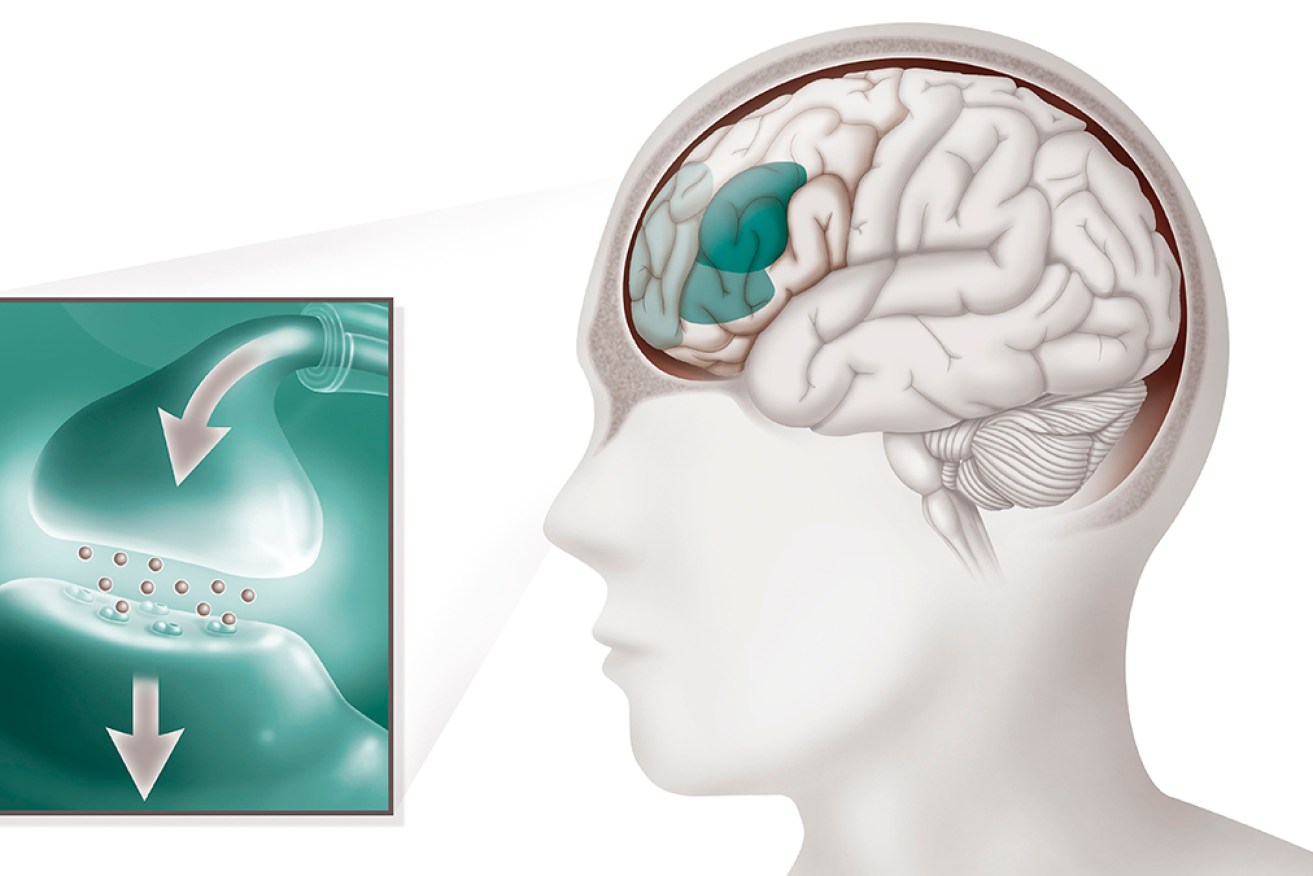 The cerebral areas in the frontal lobe, responsible for attention, organisational skills (dark green area) and emotional responses (light green area) are abnormally active with ADHD. 