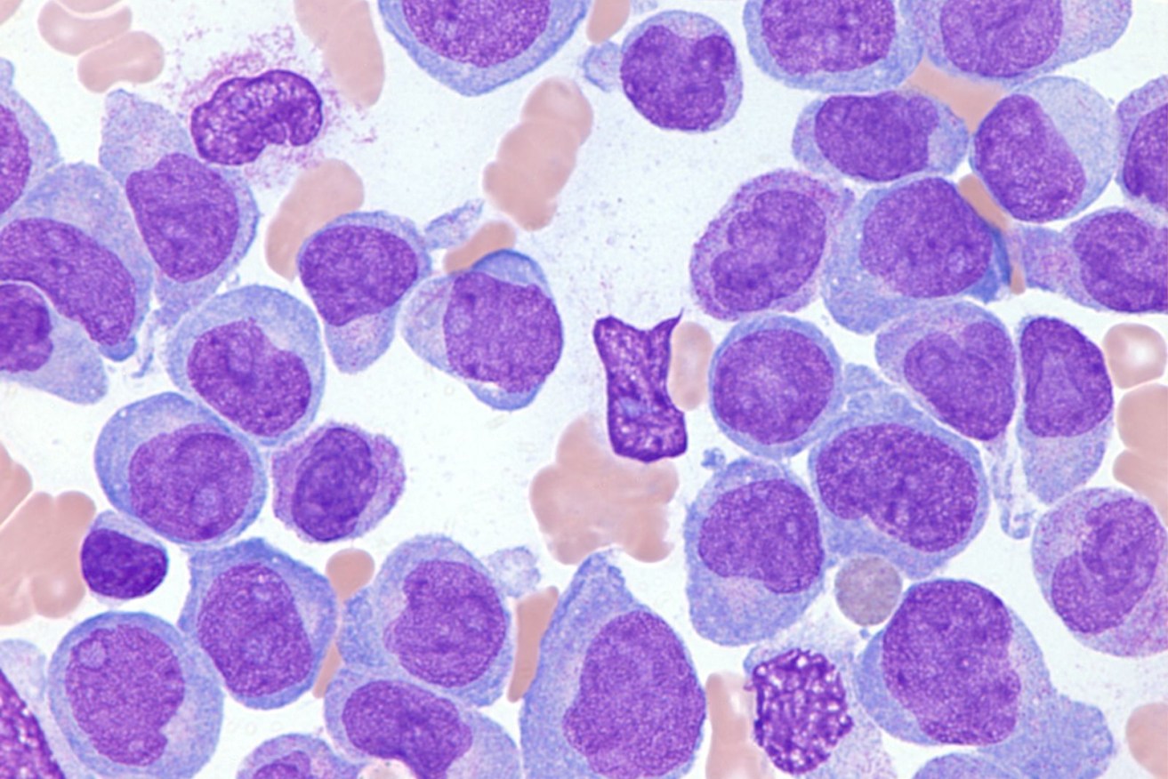 Bone marrow of a child with acute myeloid leukemia.
