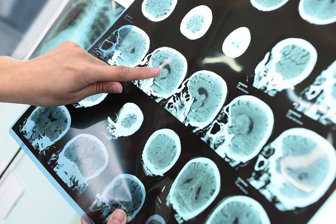 Medical science can identify early onset dementia, but sufferers are increasingly on their own after that. <i>Shutterstock</i>