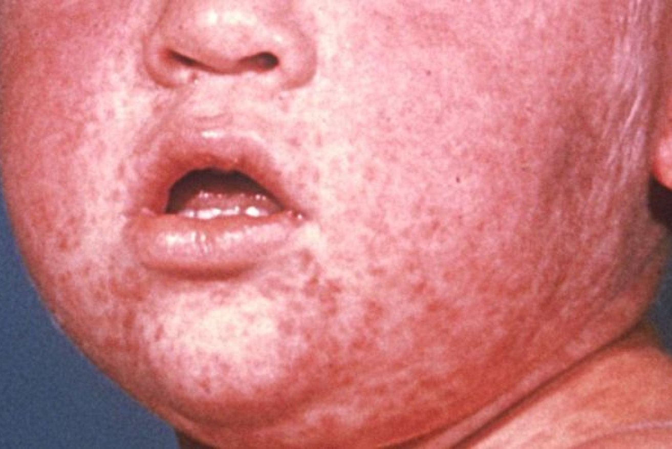 Three days after the first spots appear, this is what an unvaccinated child looks like.