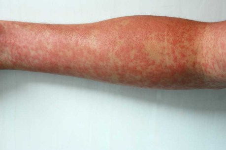 Measles fears in Queensland