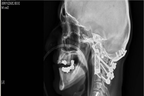 Cancer patient receives world&#8217;s first 3D-printed vertebrae