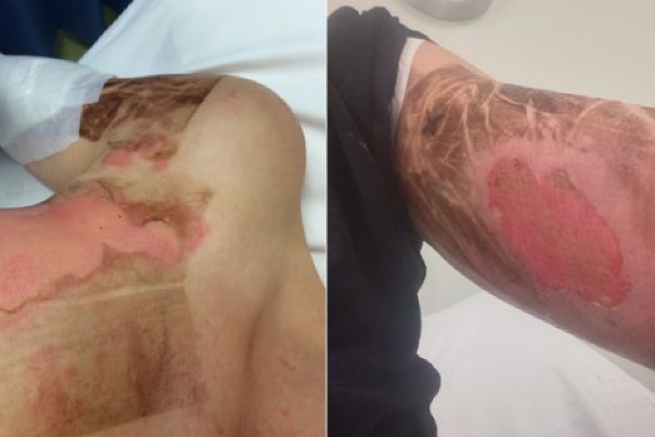 The burns required immediate hospitalisation. Photo: Supplied
