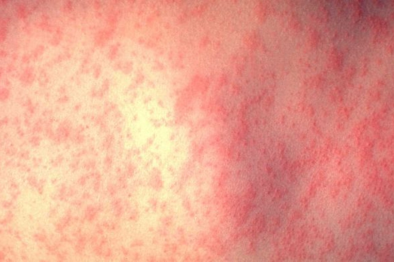 Urgent contact tracing is under way in South Australia after four new measles cases.