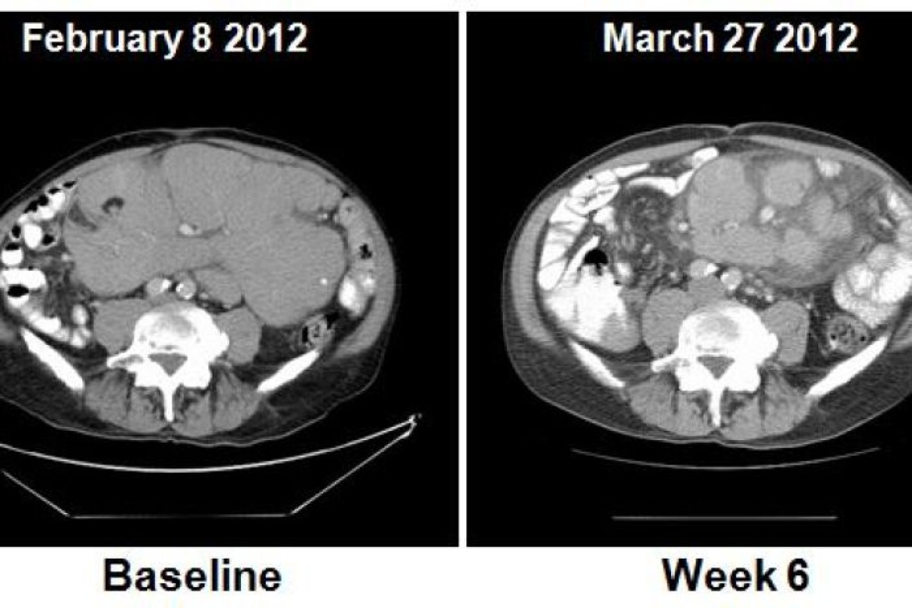 Scans showing how the drug Venetoclax reduced cancers in a patient.