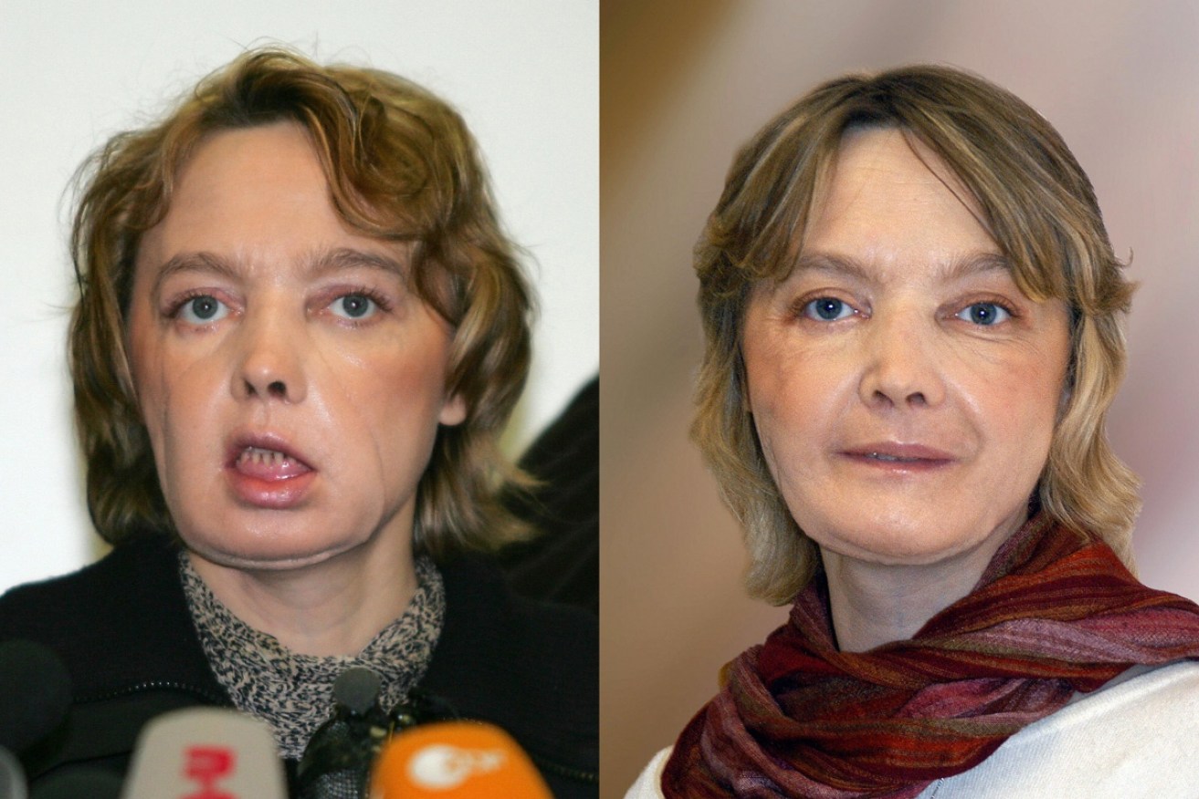 Isabelle Dinoire in (L) February 2006 and November 2006, a few months after her face transplant surgery.