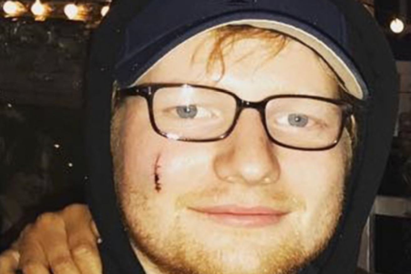 Ed Sheeran had to have stitches after the incident.