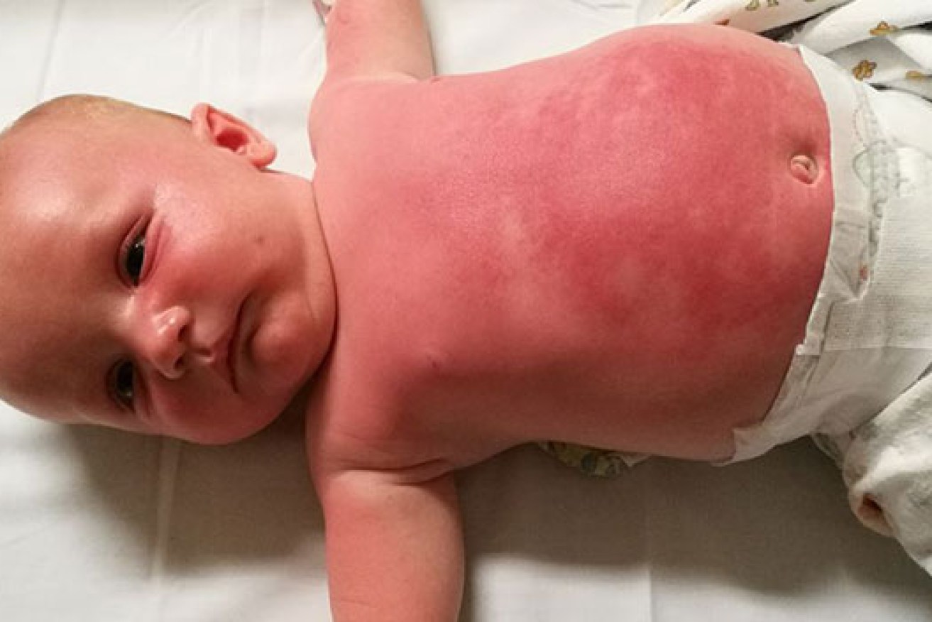 Baby Thomas spent two nights in hospital this week after using the sunscreen. 