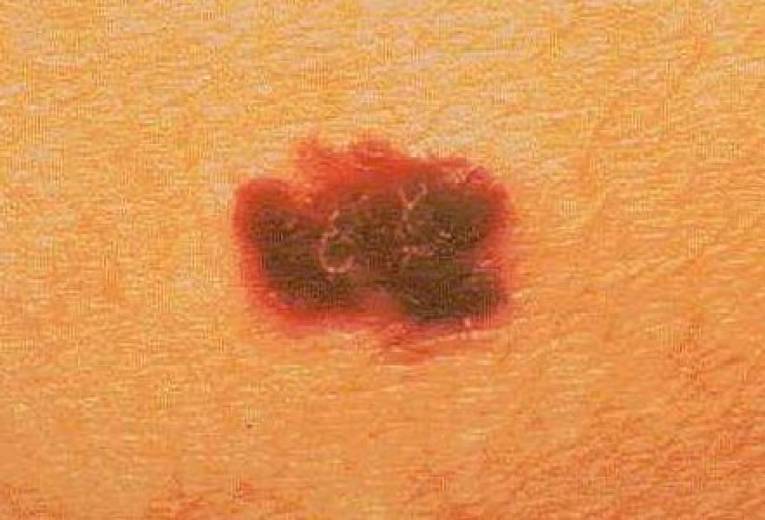 melanoma skin cancer