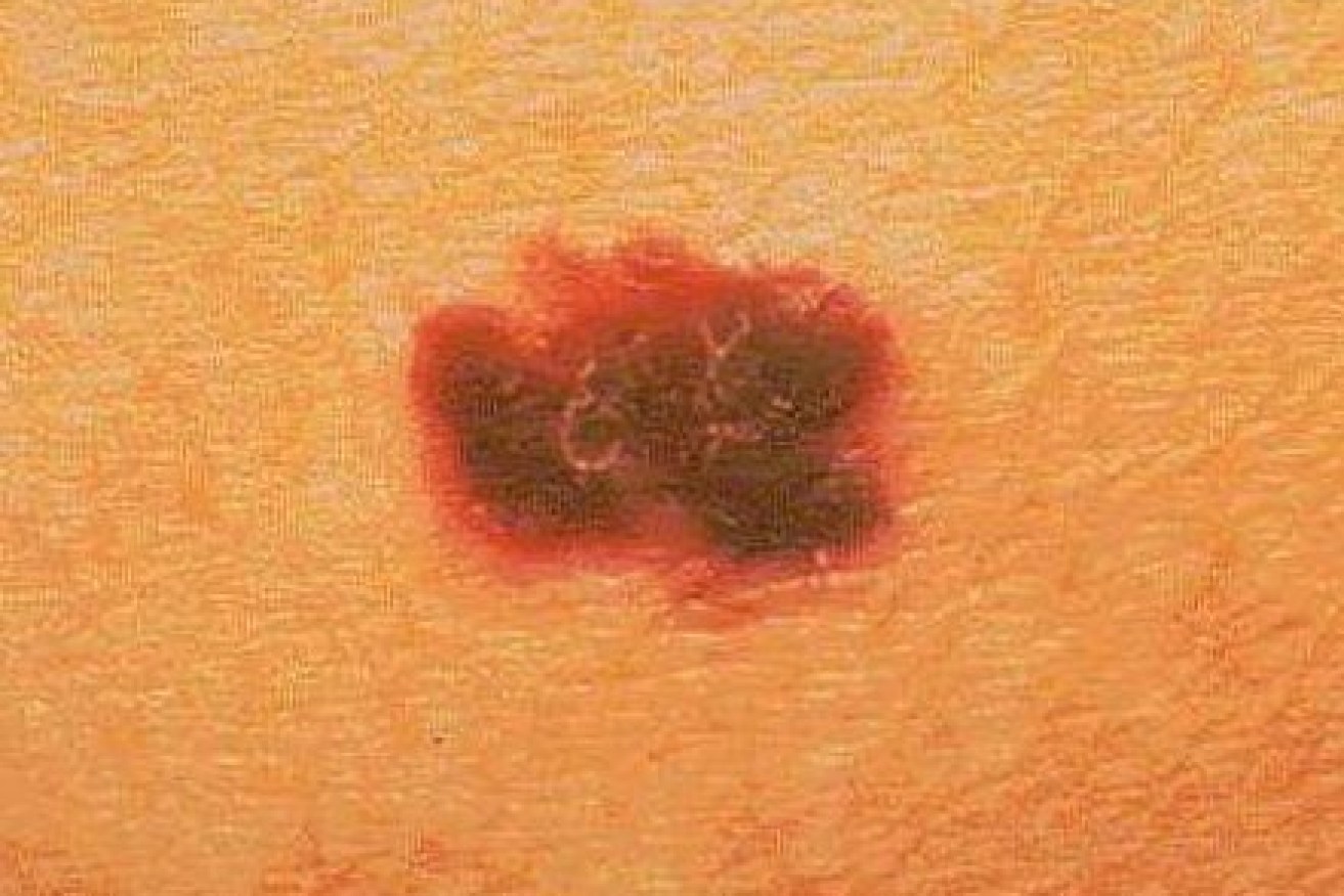 Australia has one of the highest incidences of melanoma in the world. <i>Photo: AAP</i>