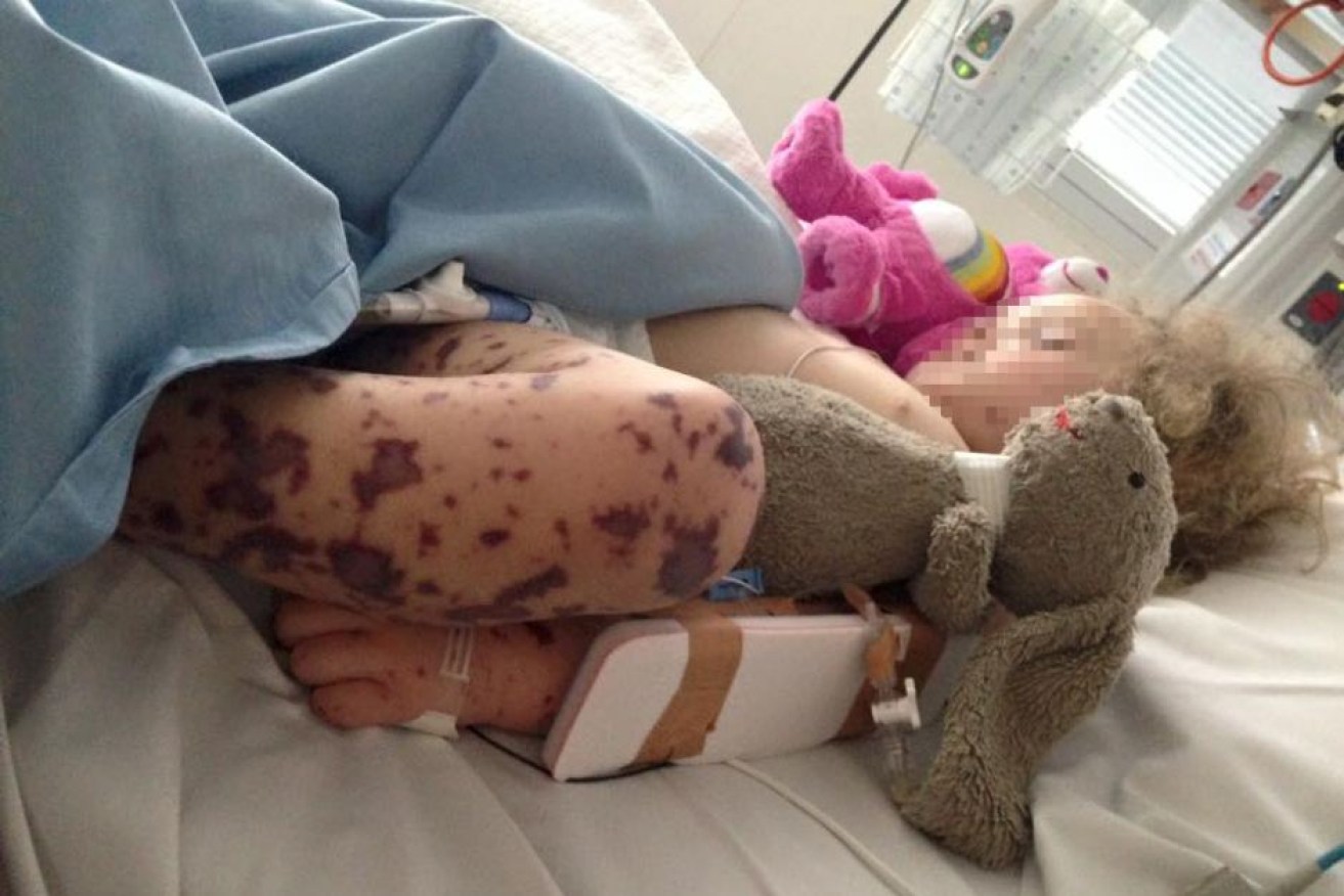 A young girl in hospital with meningococcal disease.