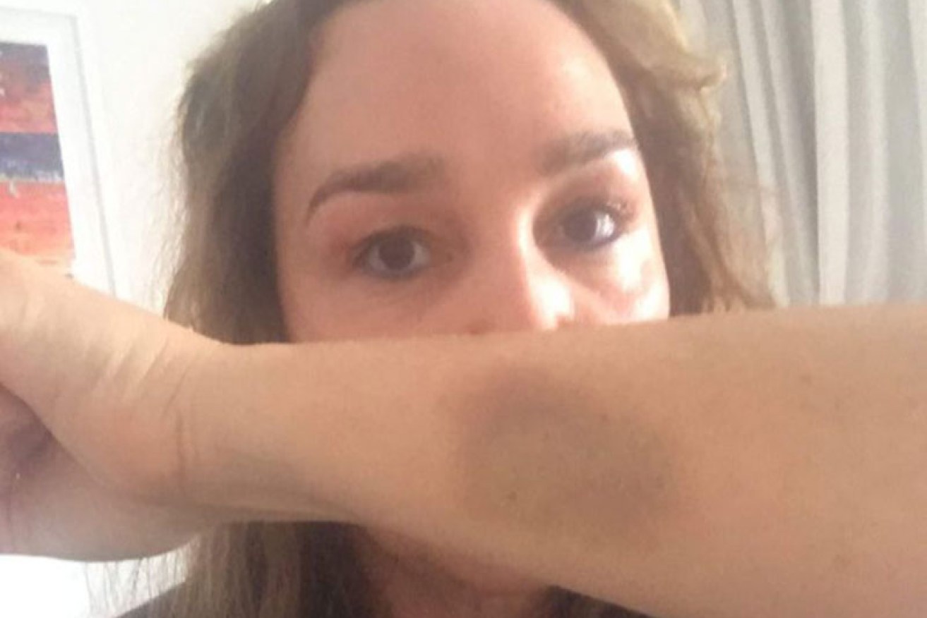 Broadcaster Kate Langbroek shows the bruise she sustained during the attack.