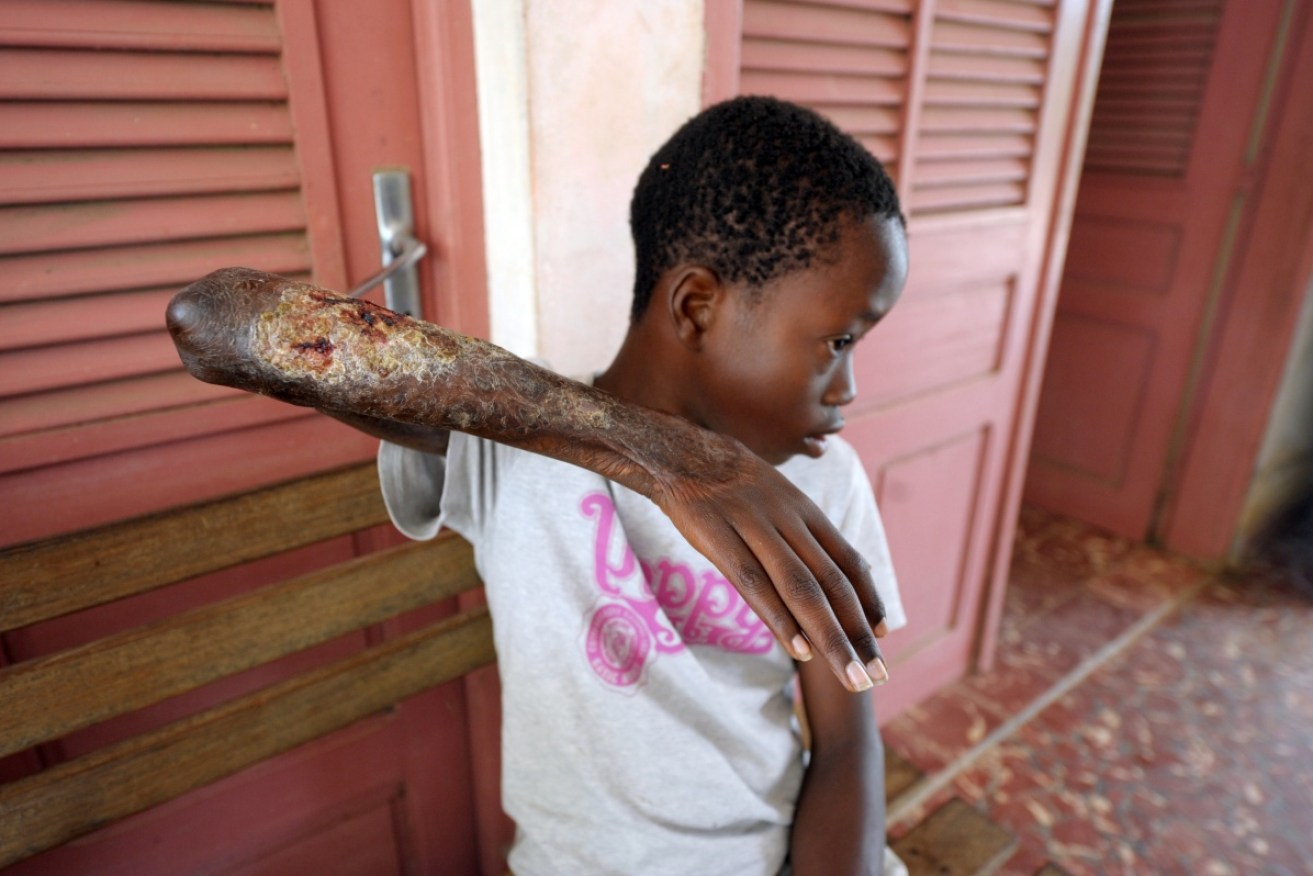 Cases of a flesh-eating disease, commonly found in West Africa, are rapidly rising in Victoria.