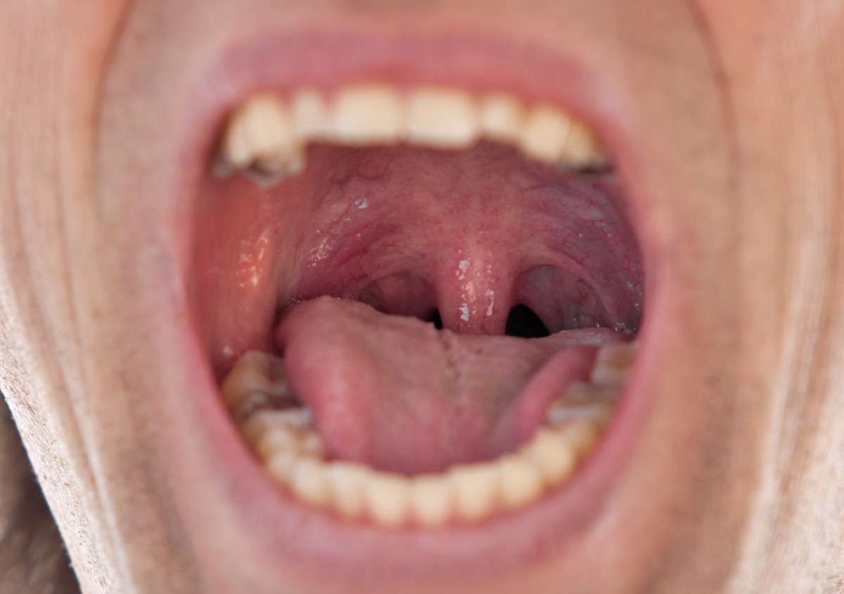 Tonsil surgery might raise other risks | The New Daily