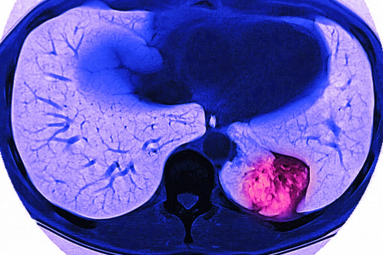 Lung cancer is traditionally picked up by MRI. 