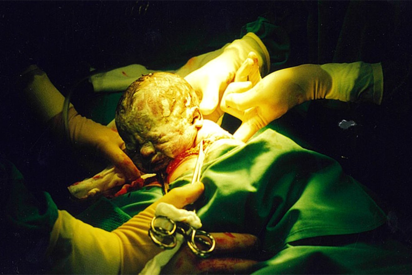 Dr Stan Tsocanos delivers a baby girl by caesarean section on January 8, 1998.