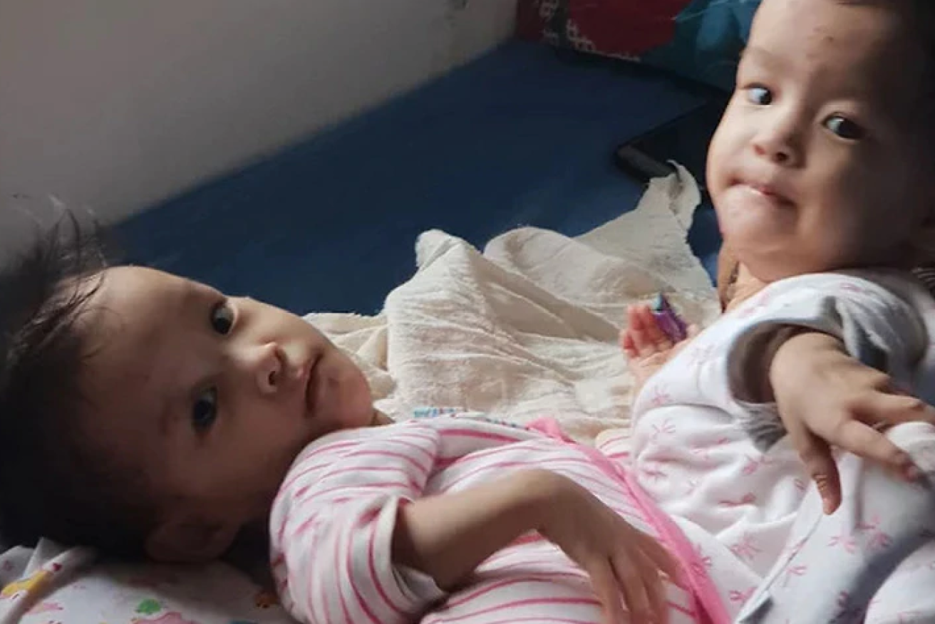 The surgical team at the Royal Children Hospital are optimistic about the separation surgery that lies ahead for conjoined twins Tony and Dawa. Photo: Children First Foundation