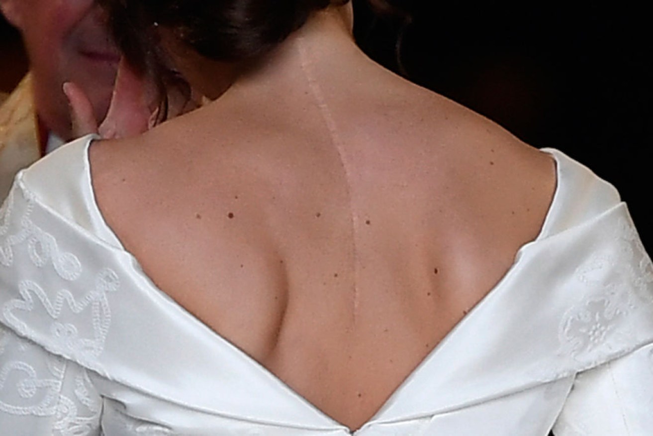 The scar on the back of Princess Eugenie of York is clearly visible with her choice of dress design.