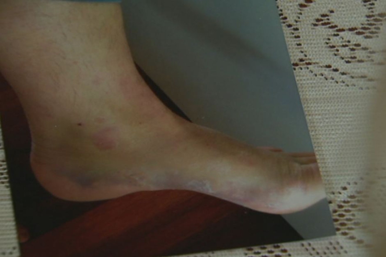 Bruising on Yvonne Berry's foot as a result of the incident.