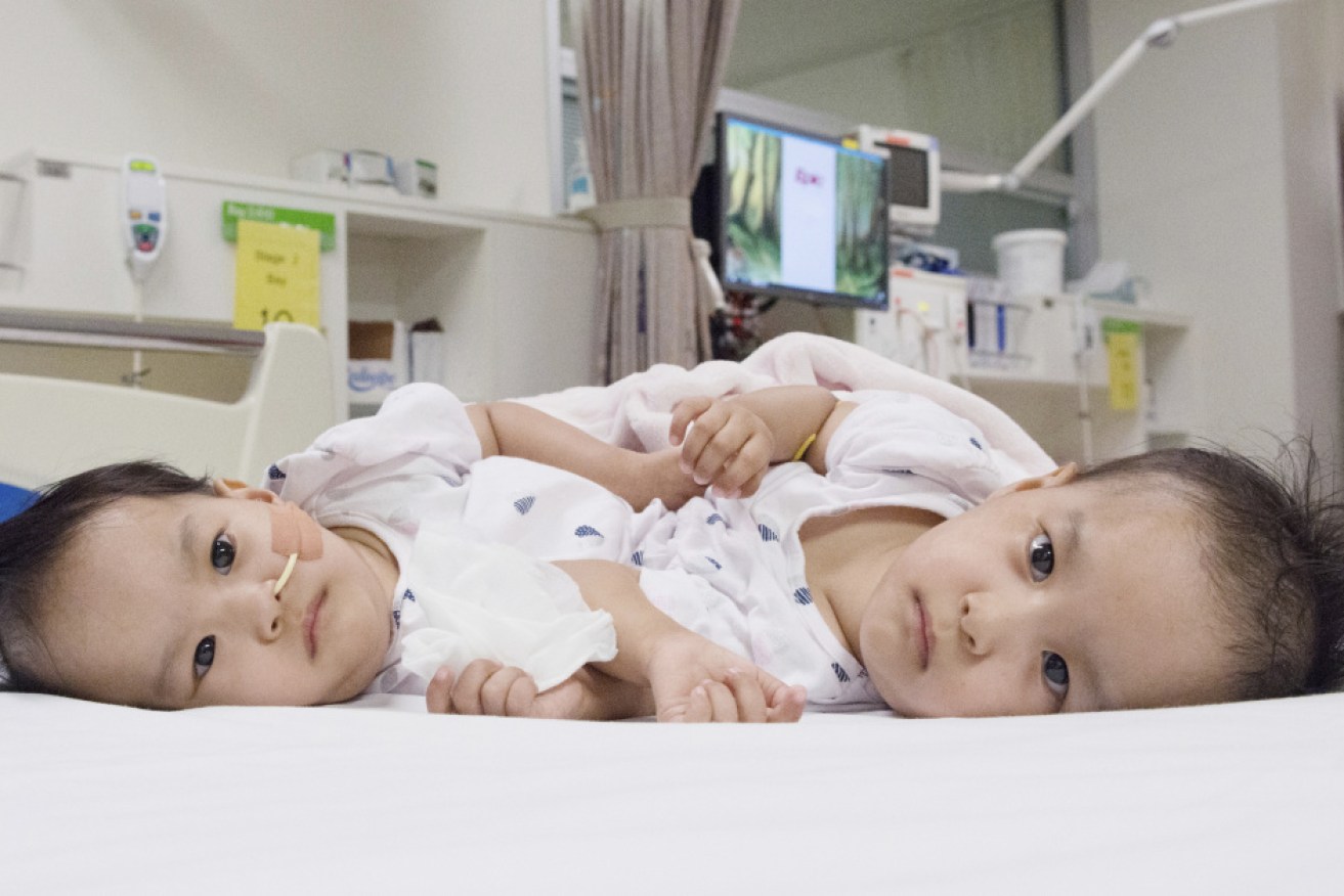 The 15-month-old girls before surgery at the Royal Children's Hospital.