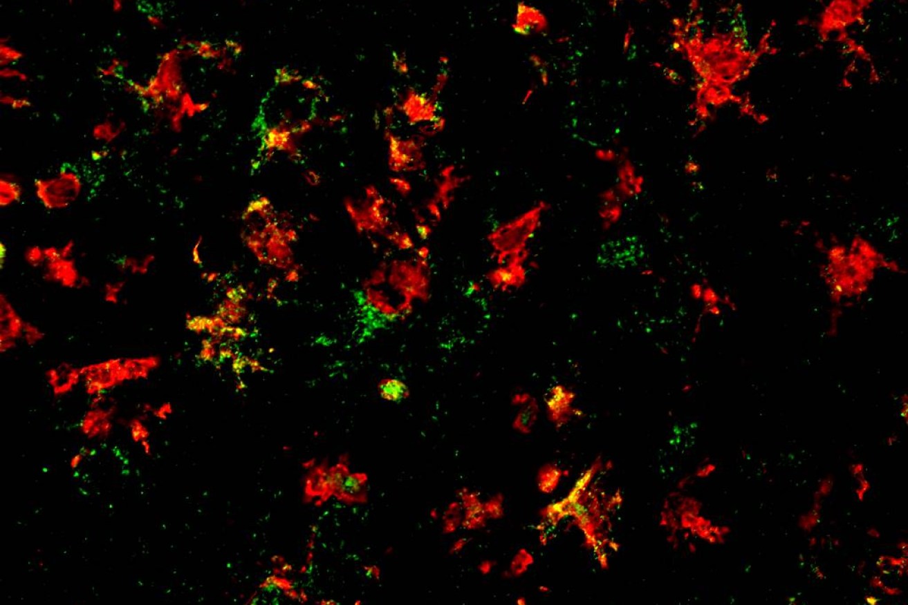 The damaging inflammation in Parksinson's (green) is a damaging over-reaction in the  immune cells (red) in the brains of people with Parkinson’s disease. The new therapy promises to cool this inflammation.  