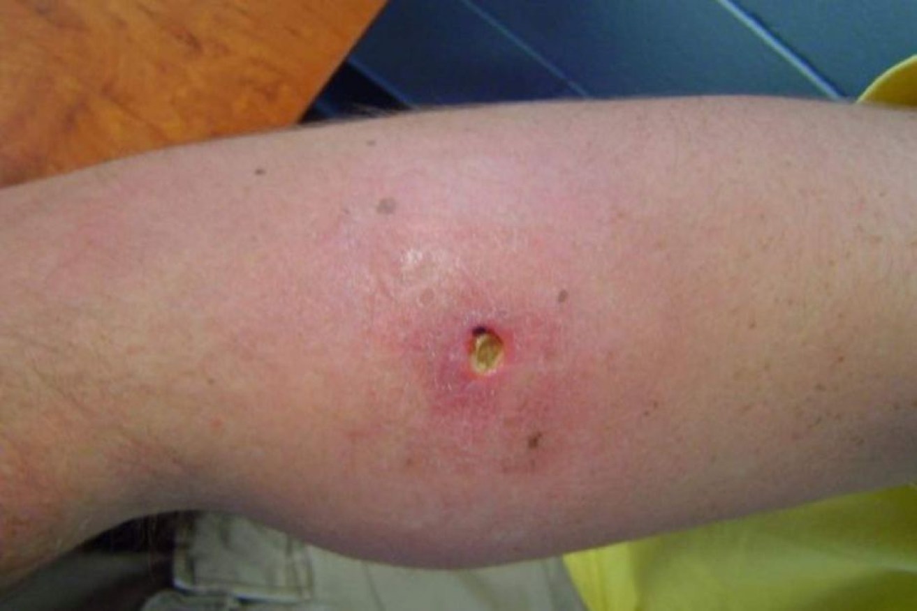 Two cases of the flesh-eating bacteria were discovered in far north Queensland in November.