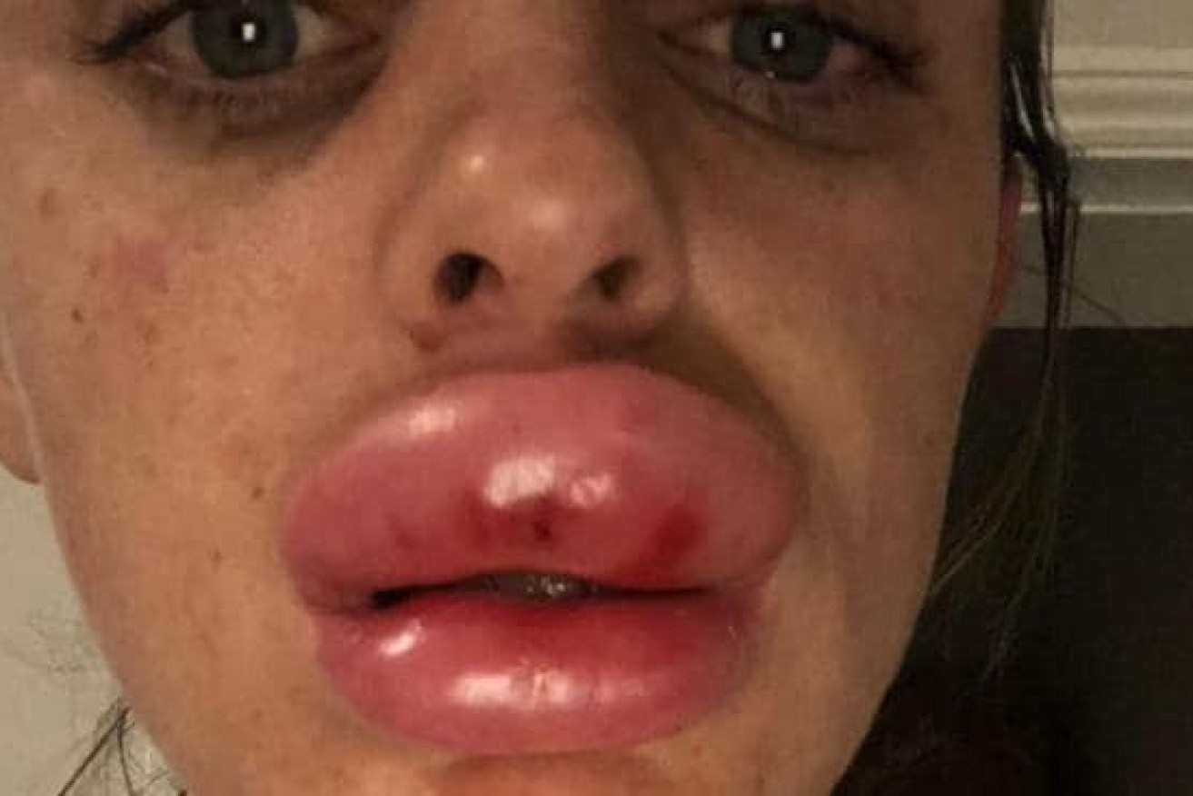 The disastrous side effects experienced by a UK woman after using cheap cosmetic filler. 