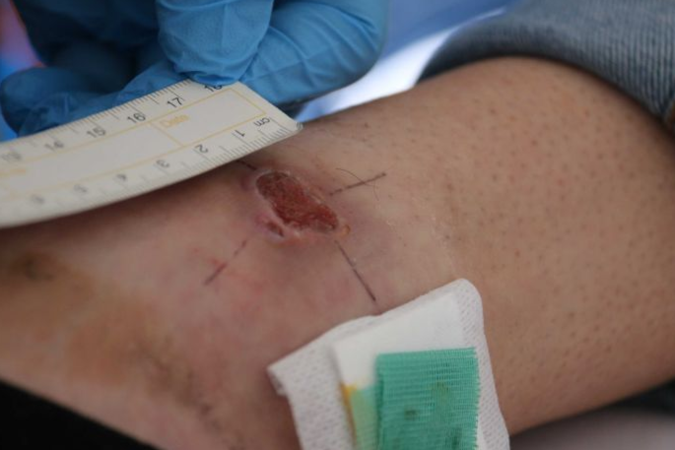 The Buruli ulcer on this ankle was the size of a 50-cent coin before it started to heal.