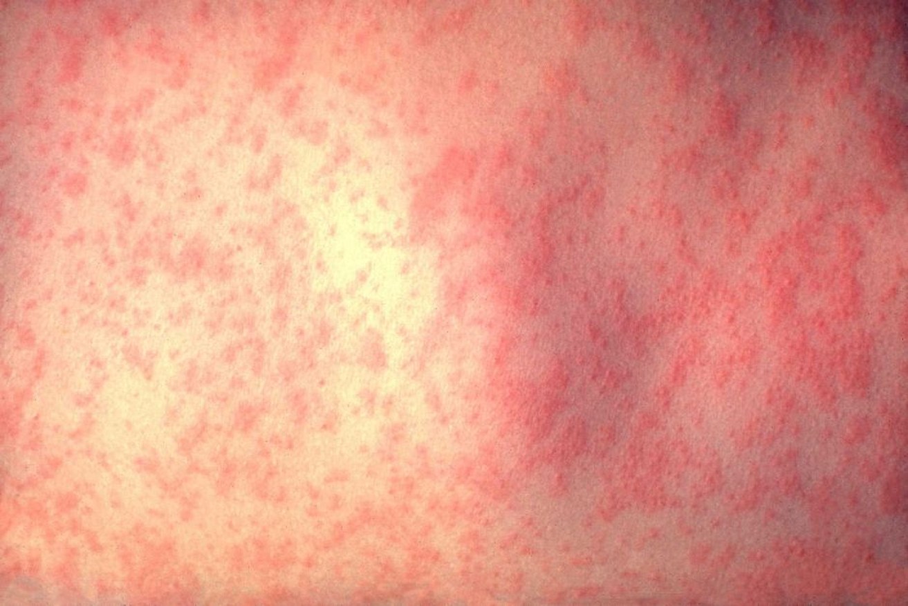 People who have not been immunised, especially children and healthcare workers, are at high risk of measles infection.

