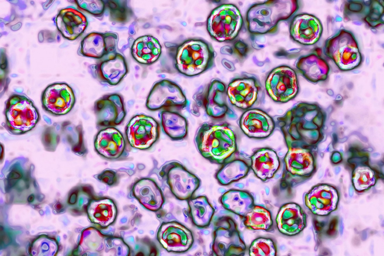 The measles virus, paramyxoviridae from the Morbillivirus family, transmission microscopy view. <i>Photo: BSIP/UIG/Getty </i>