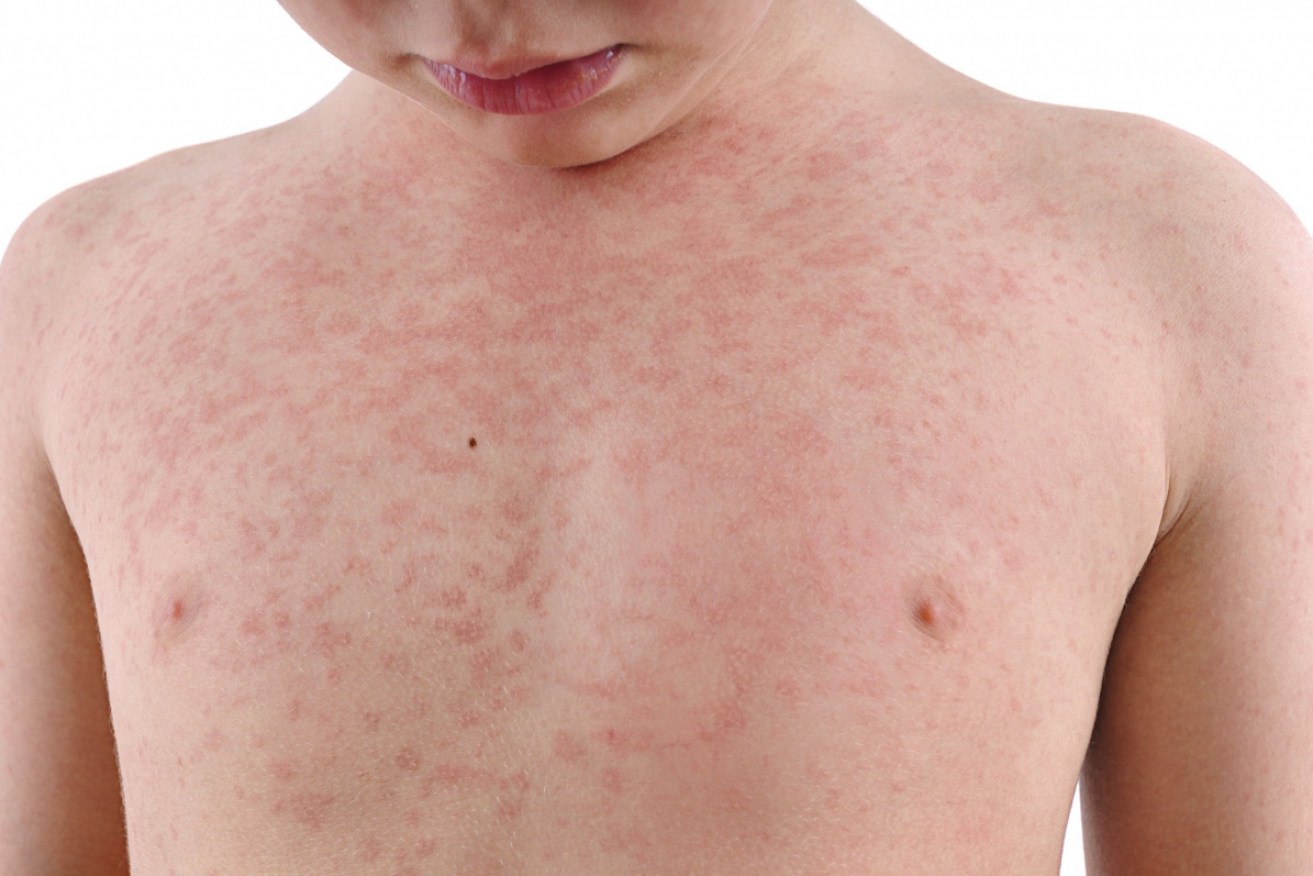 Public health authorities are warning about the risks of measles outbreaks.  