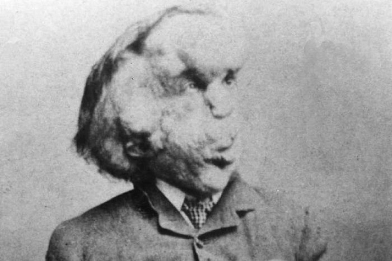 Joseph Merrick was shown in travelling exhibitions as the Elephant Man.