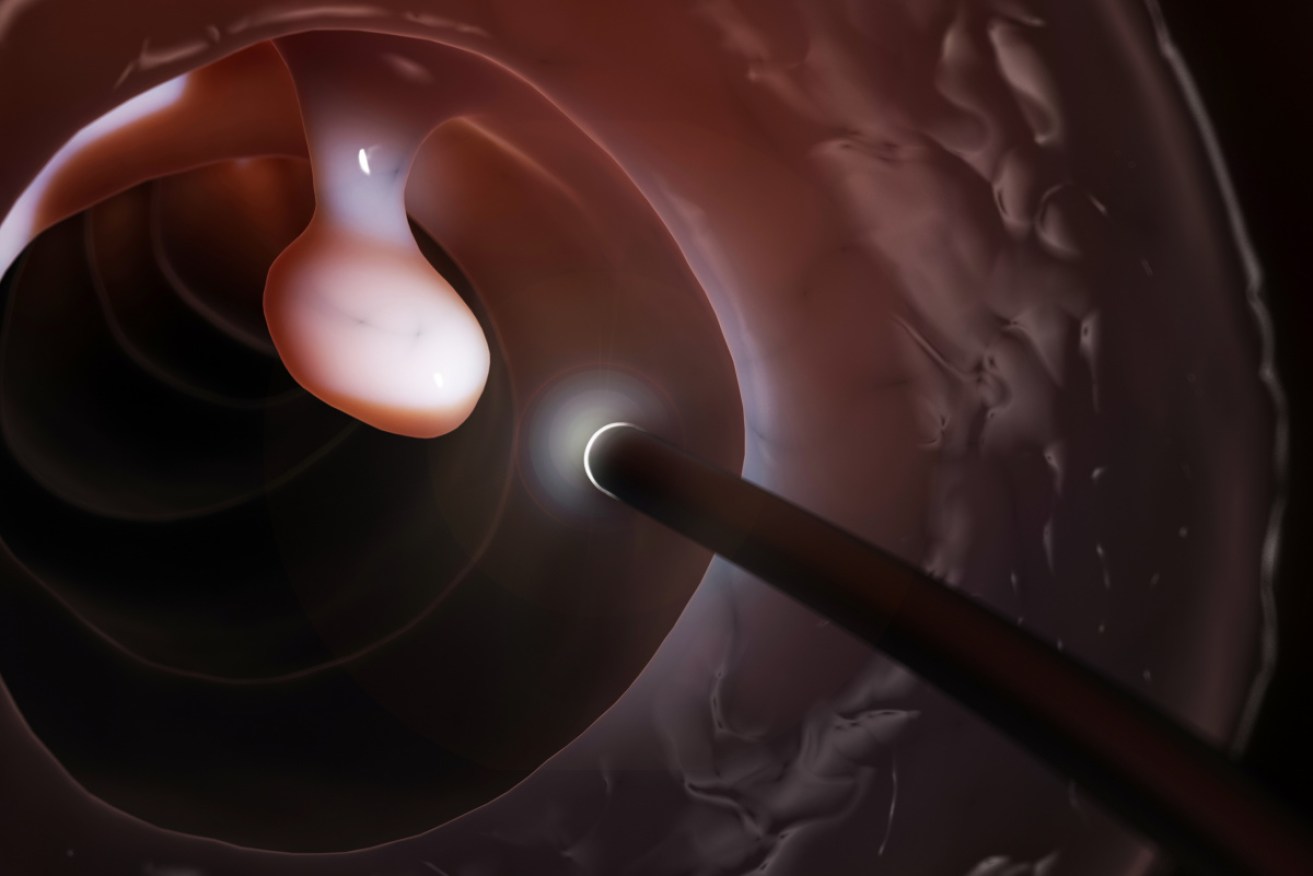 Illustration of a probe mounted with camera and light discovering a polyp in the bowel. New robot technology promises to be less invasive and more accurate.  