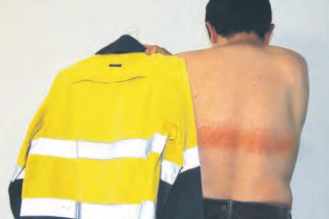 A 40-year-old Perth man's hi-vis top left him with painful burns. 
