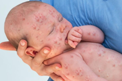 US states grapple with widening measles outbreak