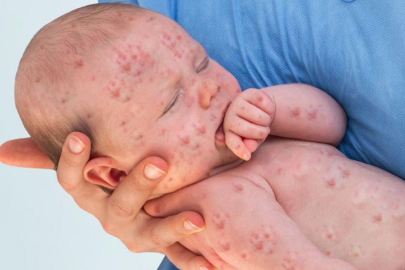 Modern medicine has minimised the danger of measles, which was one a leading cause of deaths in young children.