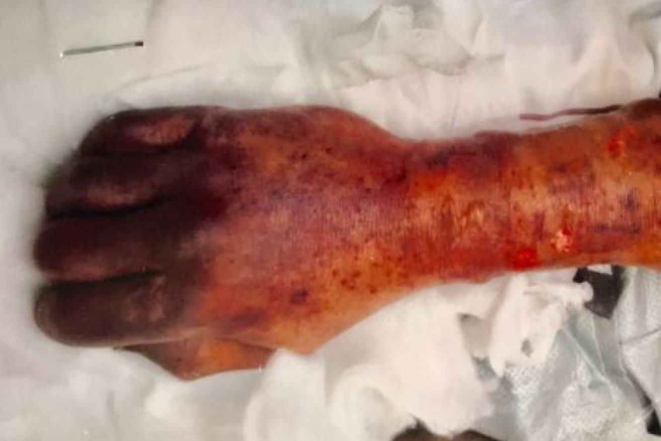 A rare case of capnocytophaga canimorsus causes blood spots on a man's hand.