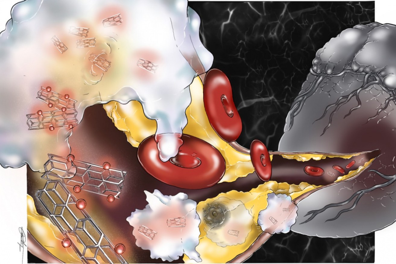 A diagram depicting the nanoparticles' carbon nanotubes at work on a plaque deposit.