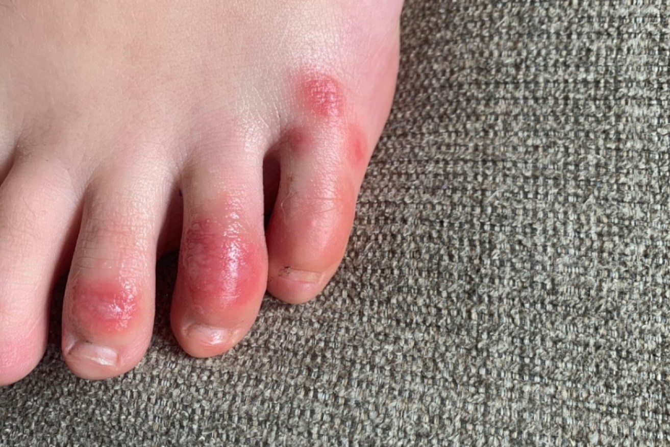 A teenage patient's foot, April 3, 2020, at the onset of the skin condition informally called "COVID toes." 