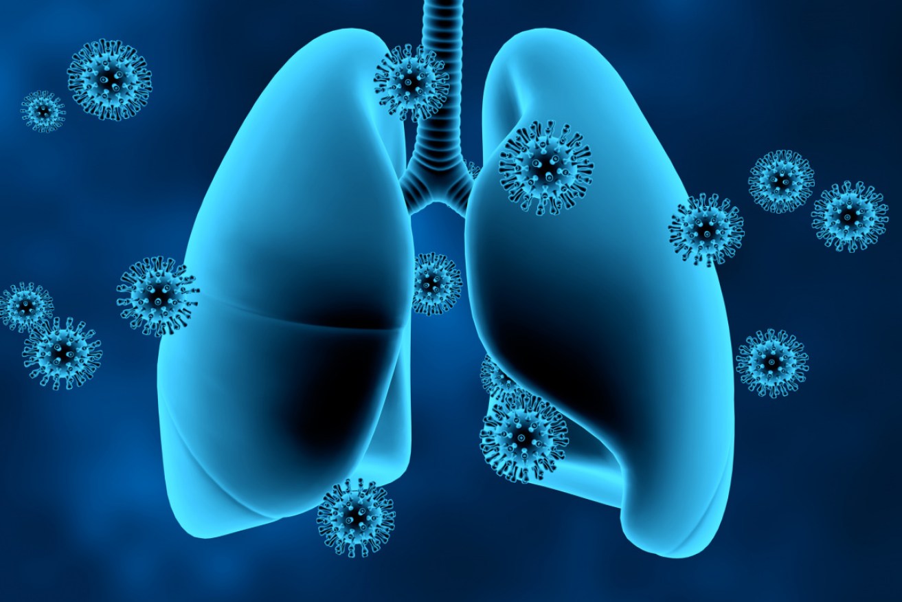 Lungs infected with pneumonia will have solid white areas on an X-ray. Photo: Getty