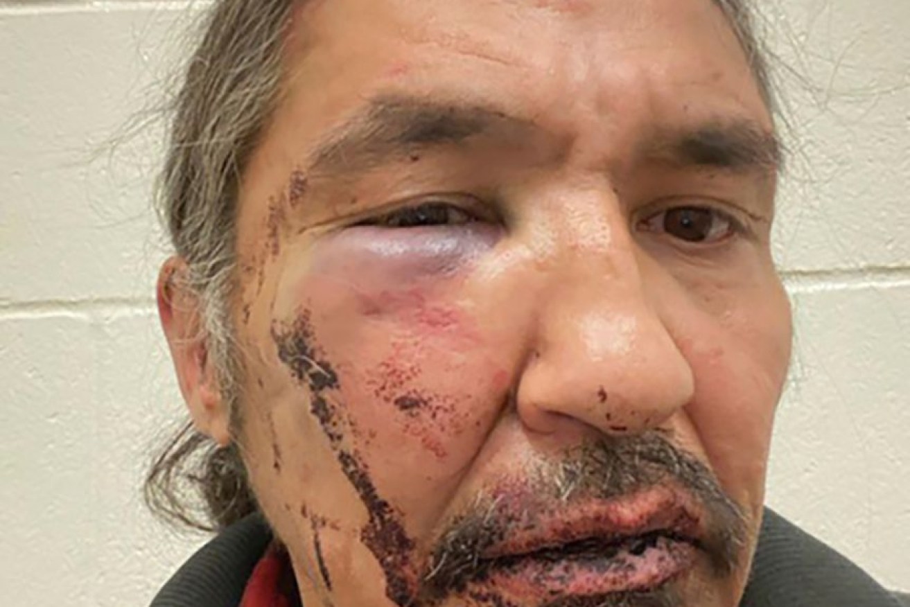 Canadian Indigenous leader Chief Adam was left with a swollen face after his March encounter with police in Alberta.