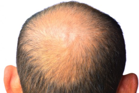 Eradicating balding a step closer with new procedure in the cross hairs