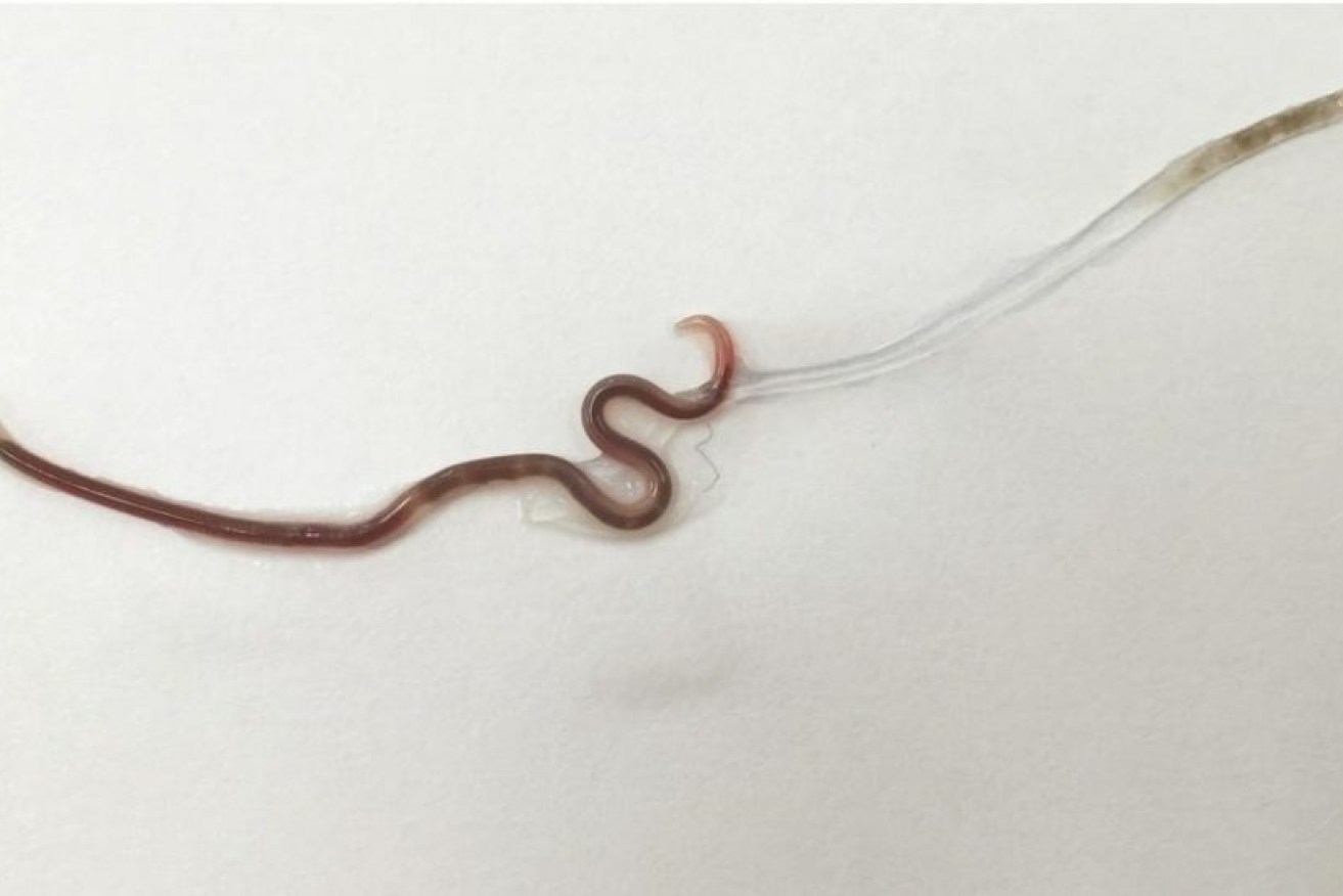 Doctors in Tokyo discovered a worm living in a patient's tonsil.