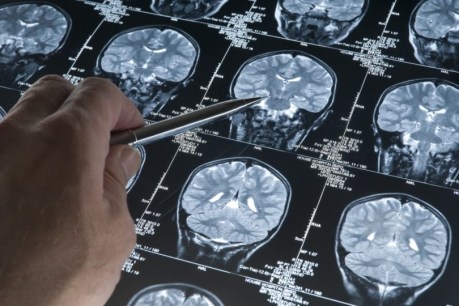 Medicine stopped in 1980s linked to Alzheimer&#8217;s cases