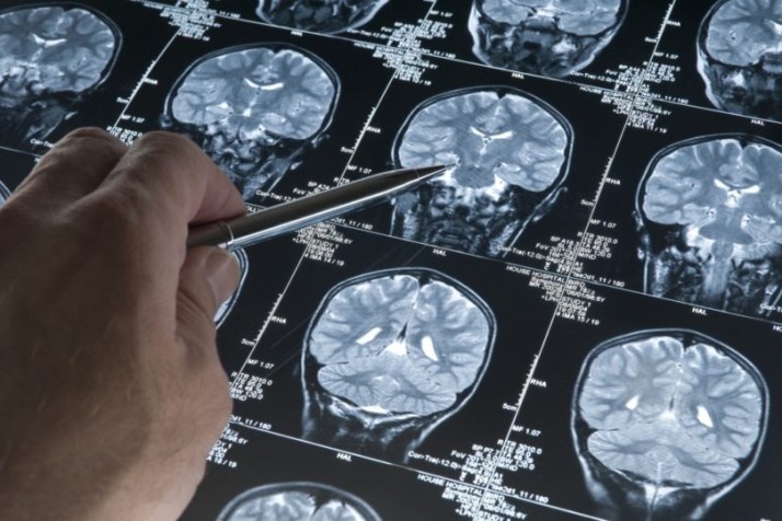Medicine stopped in 1980s linked to Alzheimer’s cases