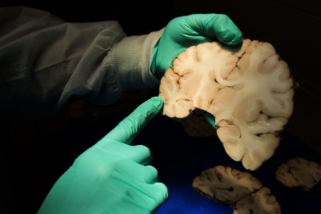CTE is a degenerative brain disease that is found almost exclusively in professional footballers. 