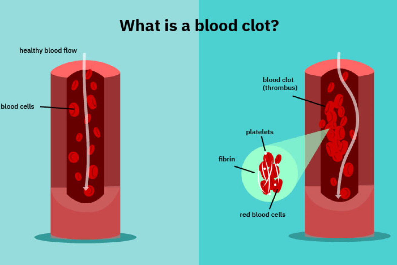 Physicians know how clots form. What they don't know is why the AstraZeneca jab appears to cause them.