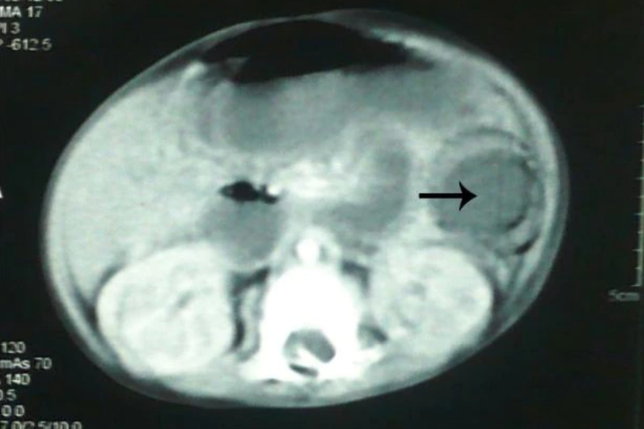The arrow indicates a bowel obstruction in a six-month-old Pakistani child who died in 2012 after ingesting a gel ball.